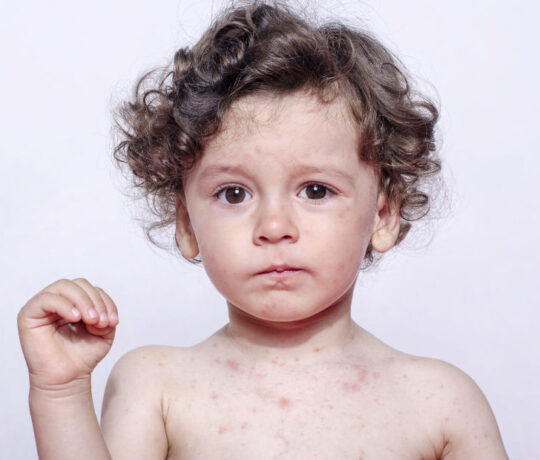 little boy with allergic reaction - rush